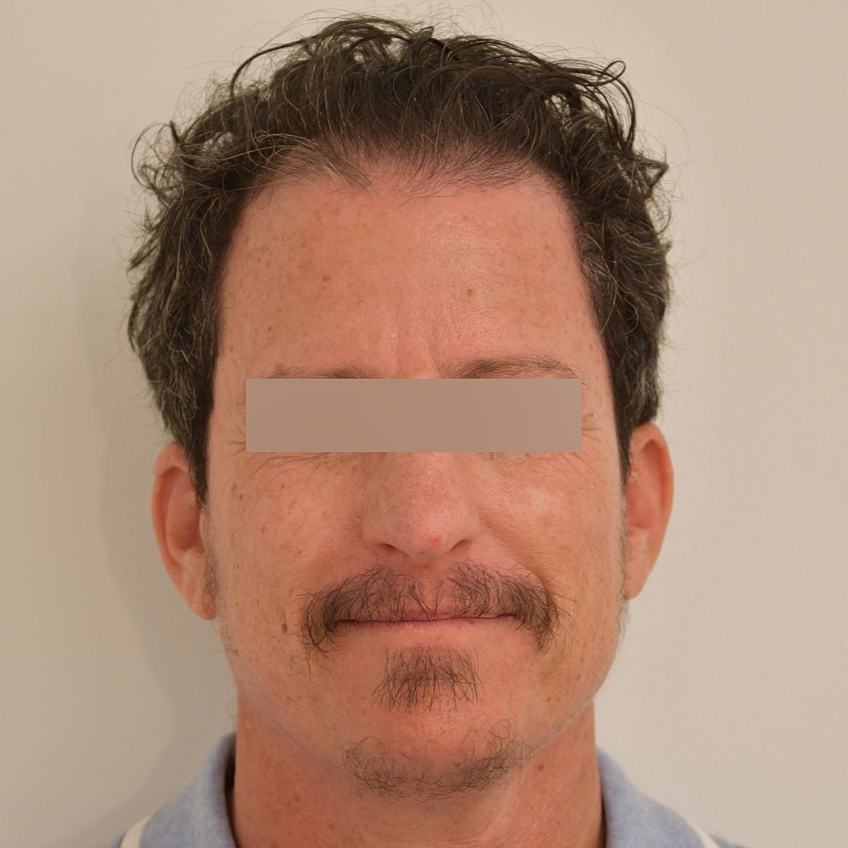 Gender-Affirming Hair Transplant (FTM) Before & After