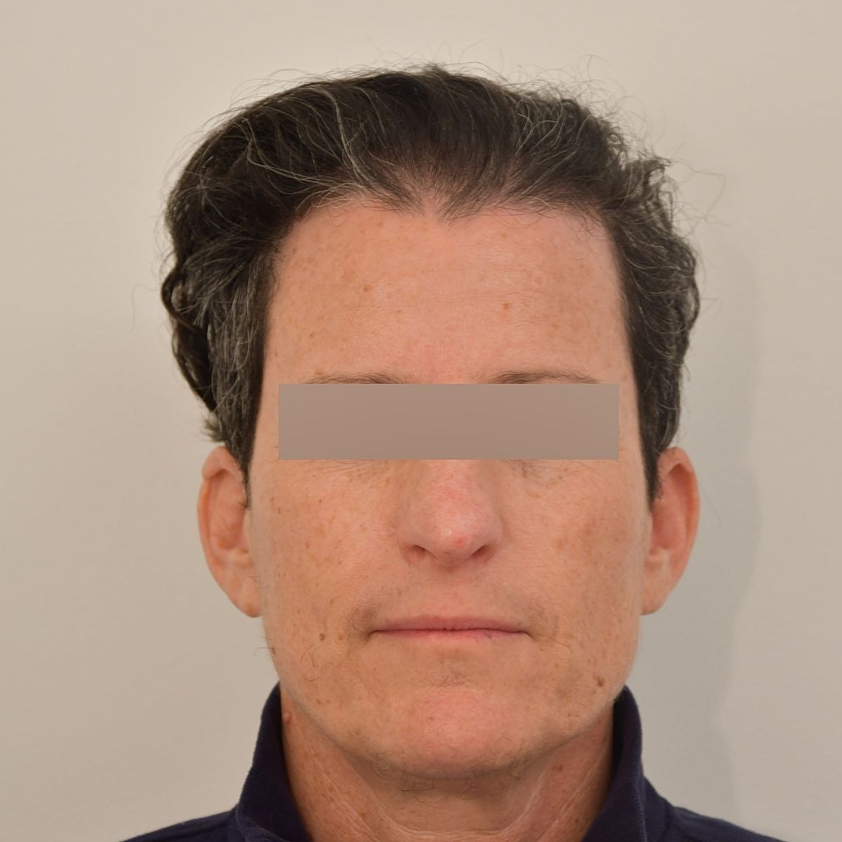 Gender-Affirming Hair Transplant (FTM) Before & After