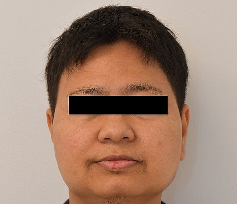 Gender-Affirming Hair Transplant (FTM) Before & After