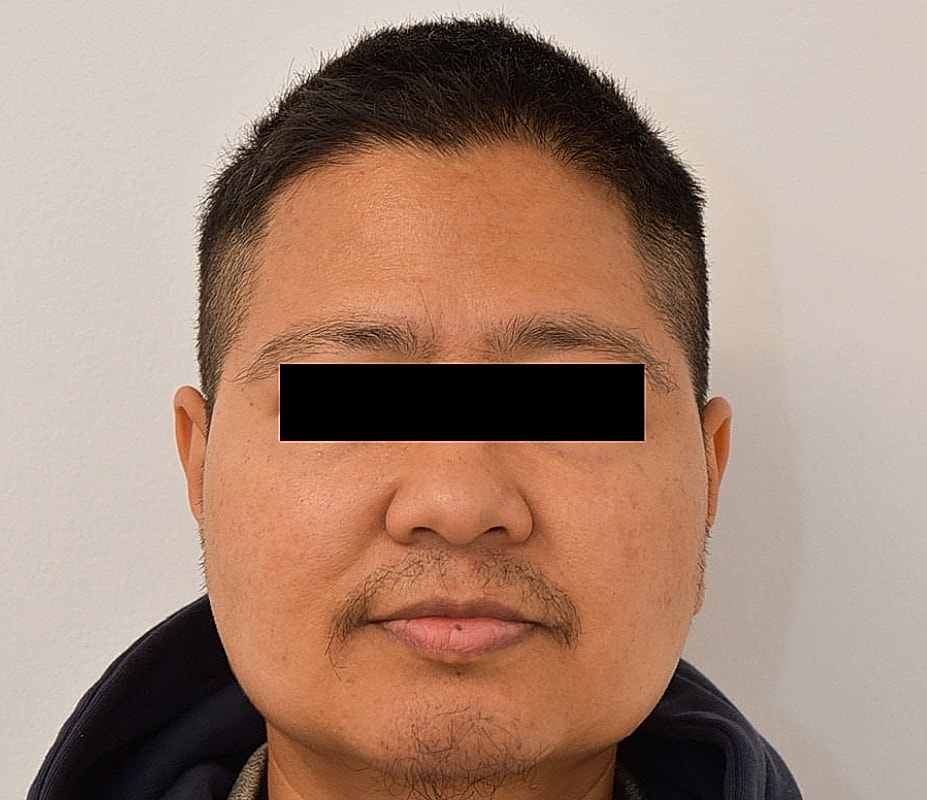 Gender-Affirming Hair Transplant (FTM) Before & After