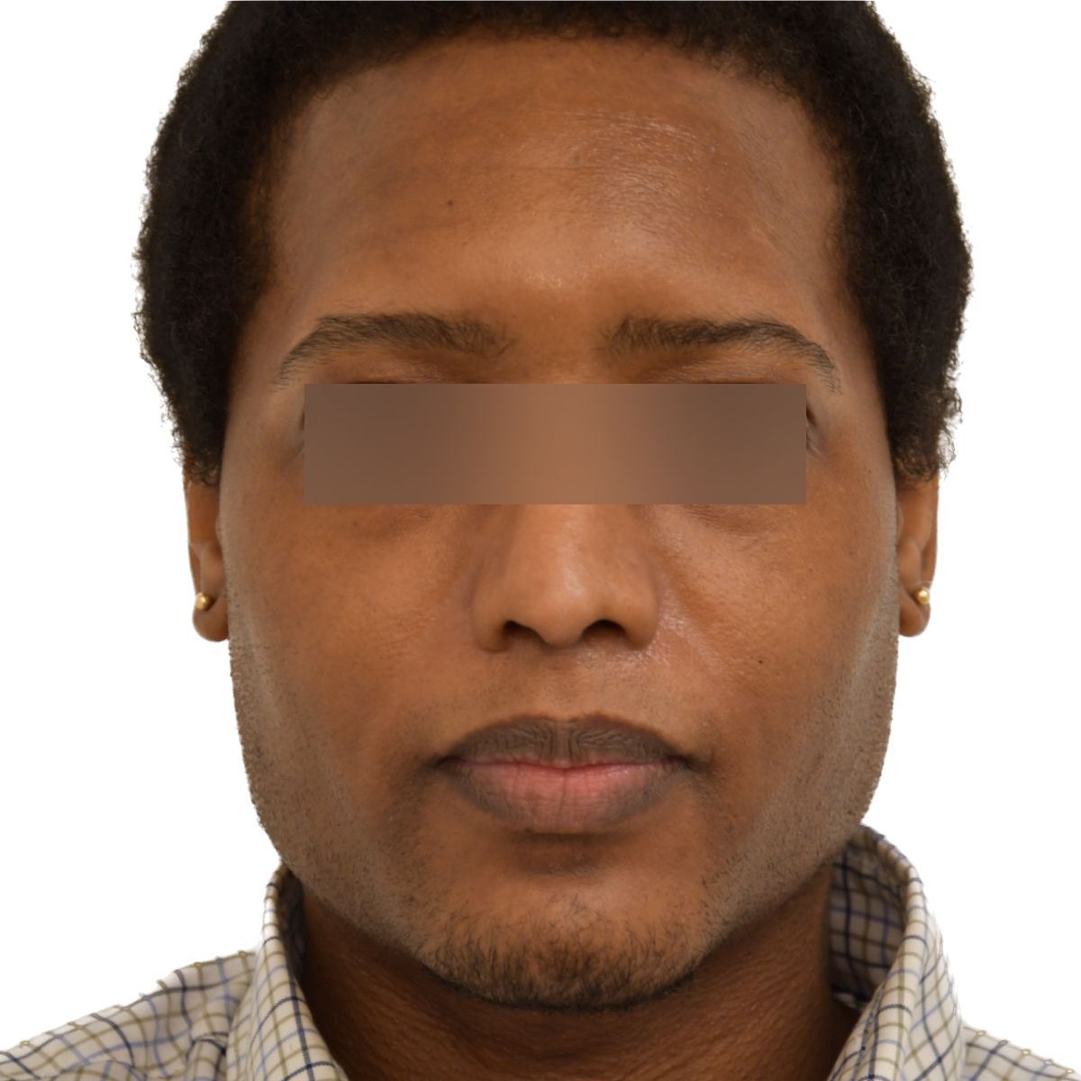 gender affirming hair transplant before