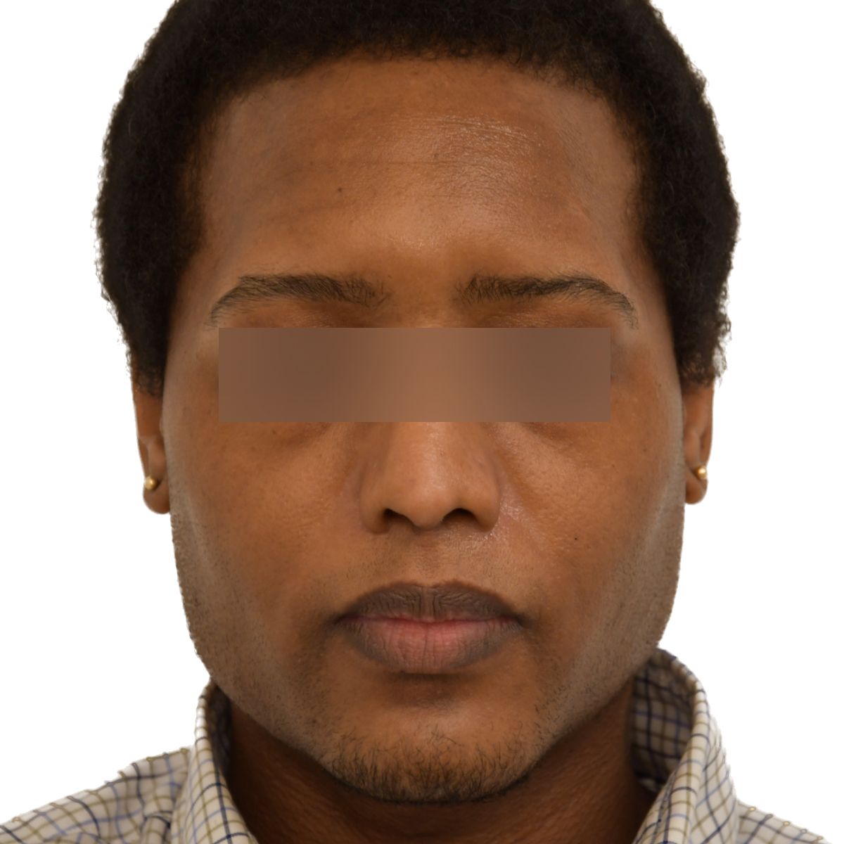 gender affirming hair transplant before