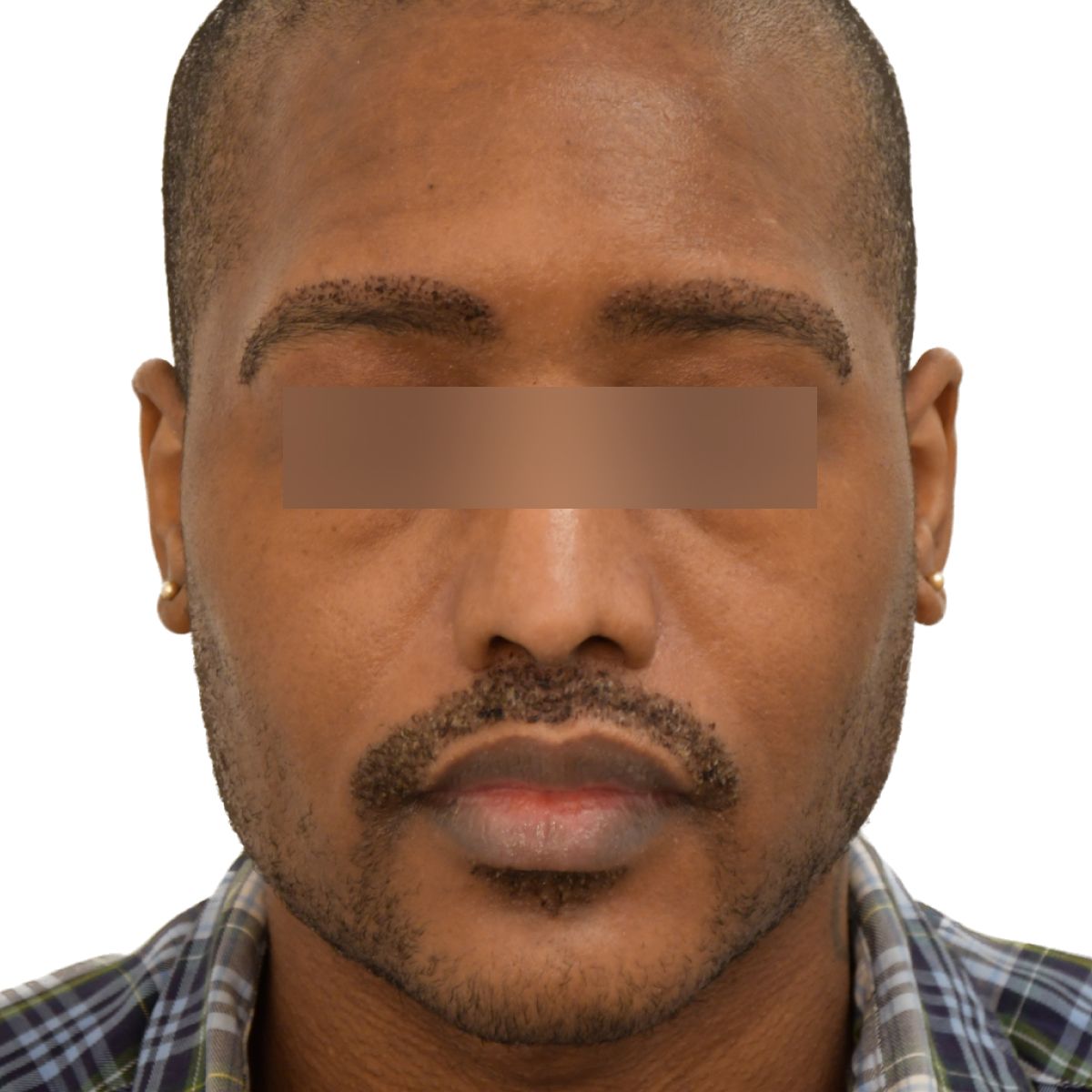 gender affirming hair transplant after