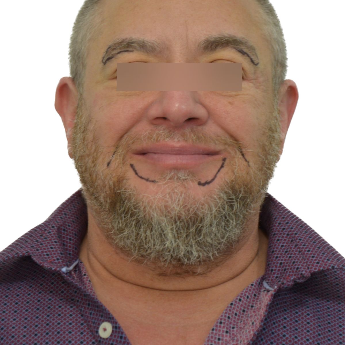 gender affirming hair transplant before