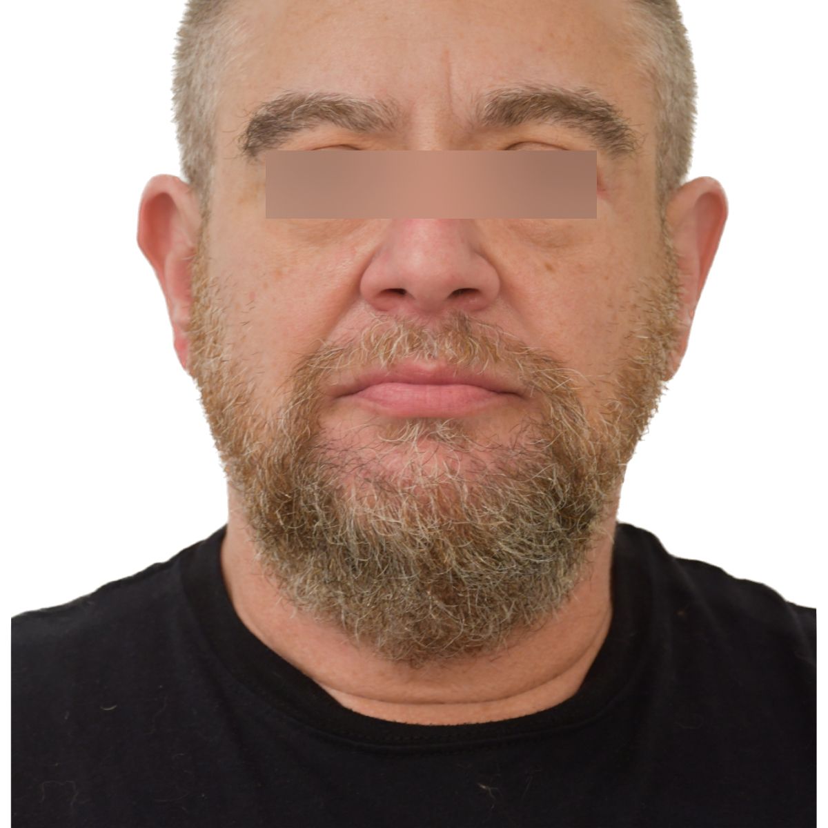 gender affirming hair transplant after