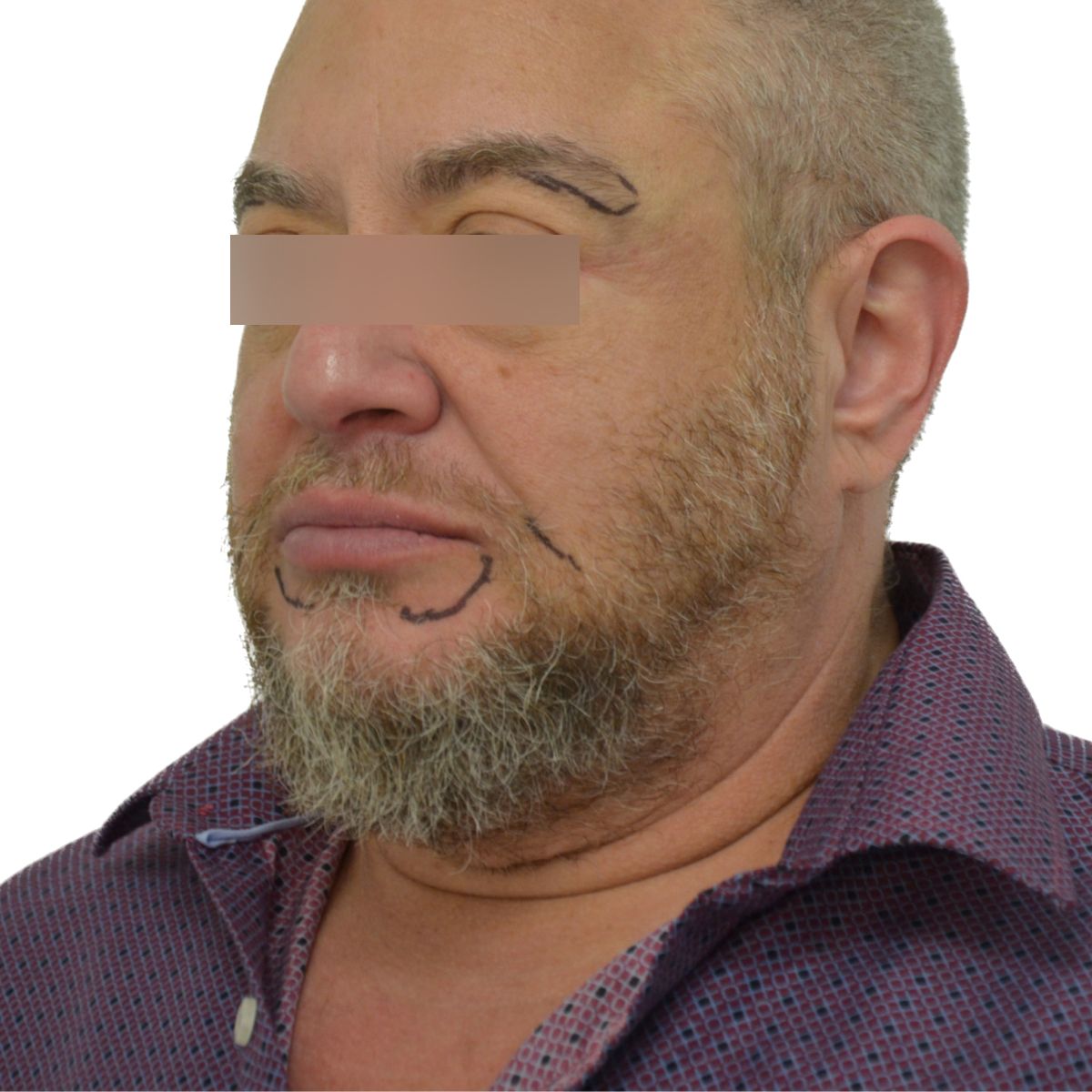 gender affirming hair transplant before