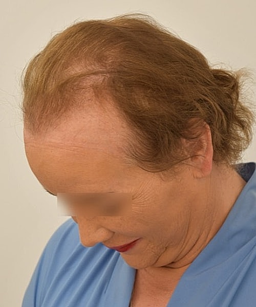 Person with thinning hair and blue attire.
