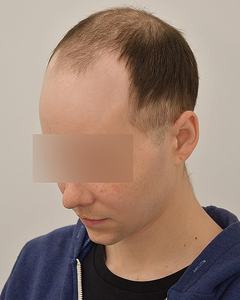 Gender-Affirming Hair Transplant (MTF) Before & After