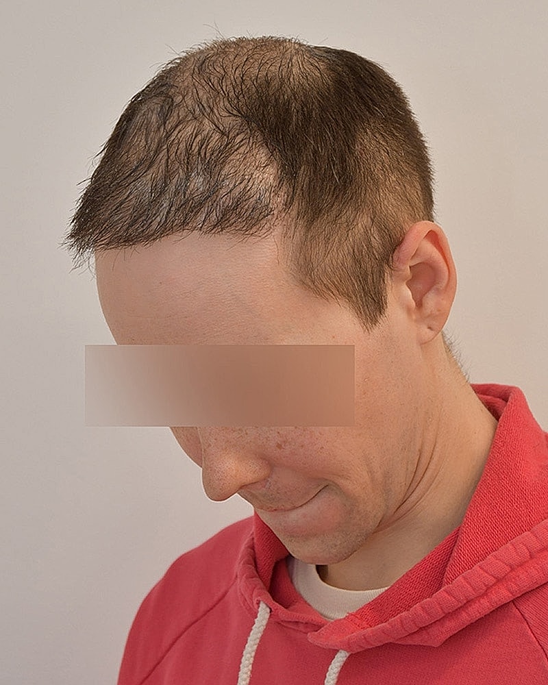 Gender-Affirming Hair Transplant (MTF) Before & After