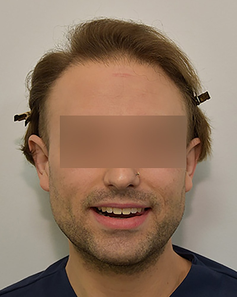 Gender-Affirming Hair Transplant (MTF) Before & After