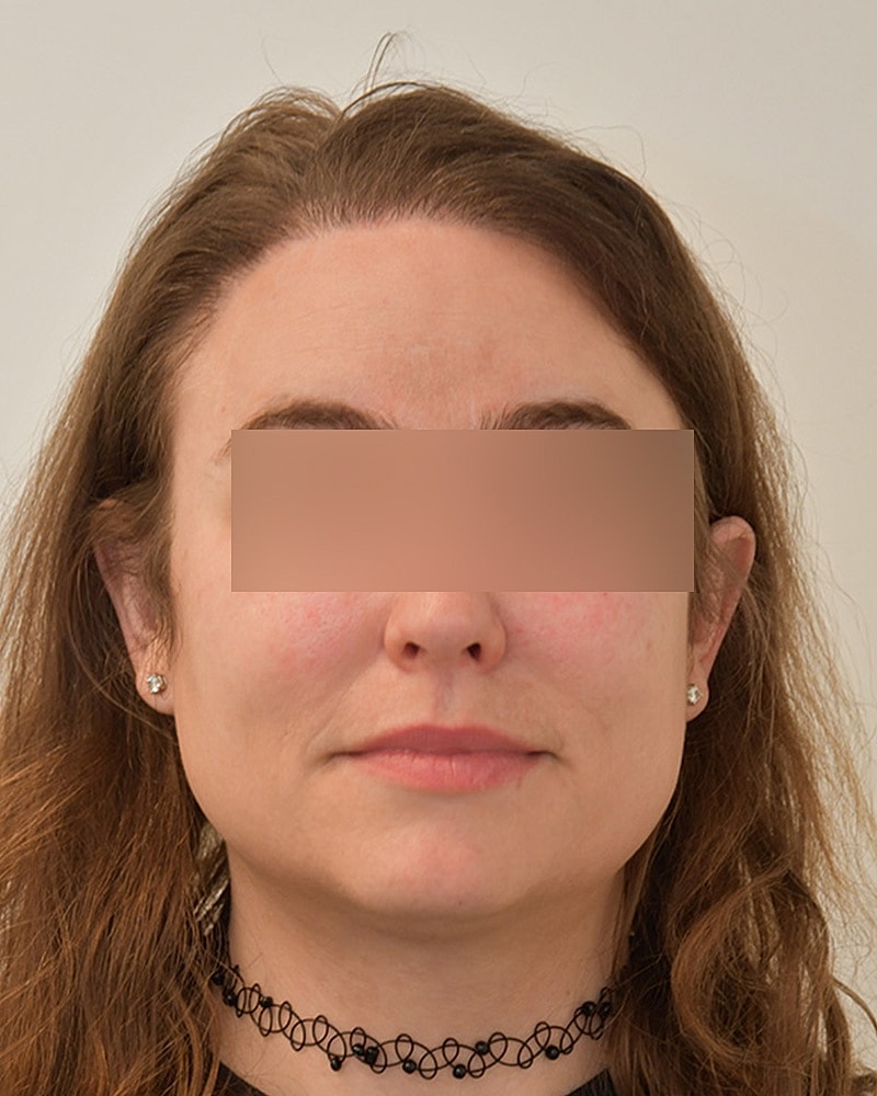 Gender-Affirming Hair Transplant (MTF) Before & After