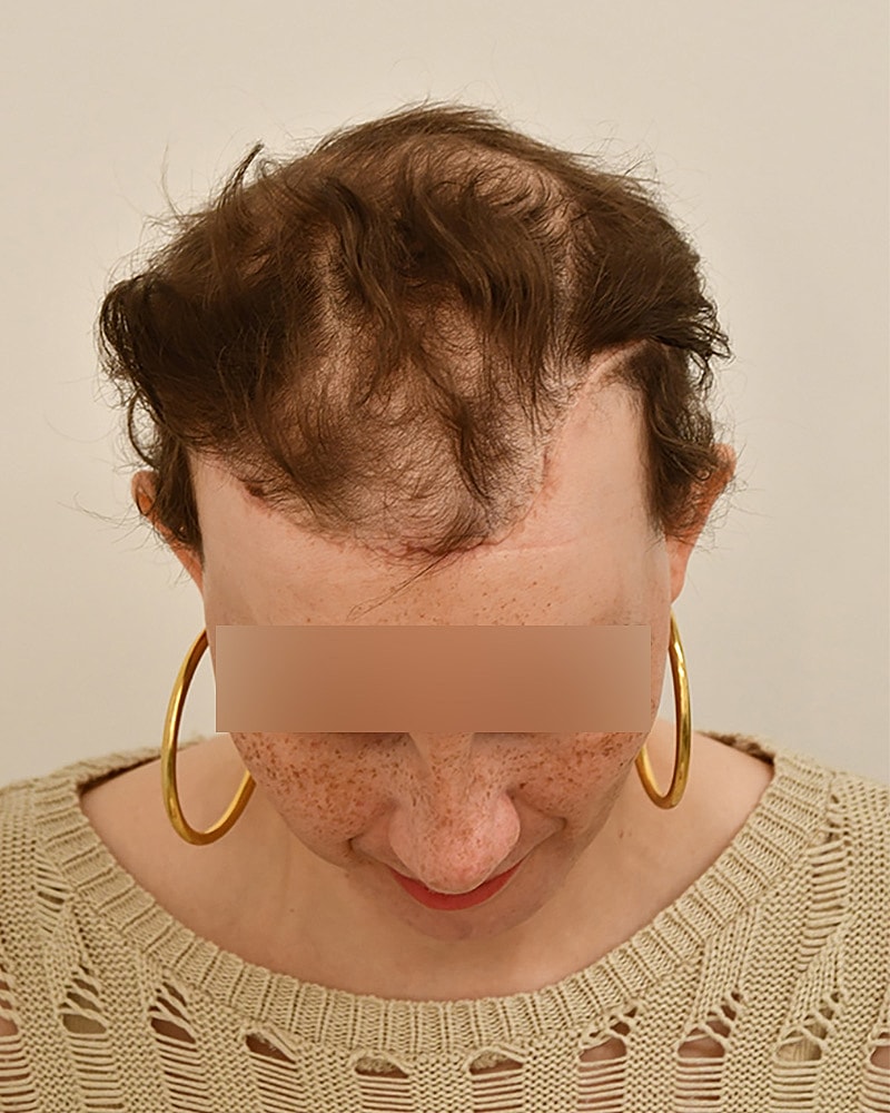 Gender-Affirming Hair Transplant (MTF) Before & After