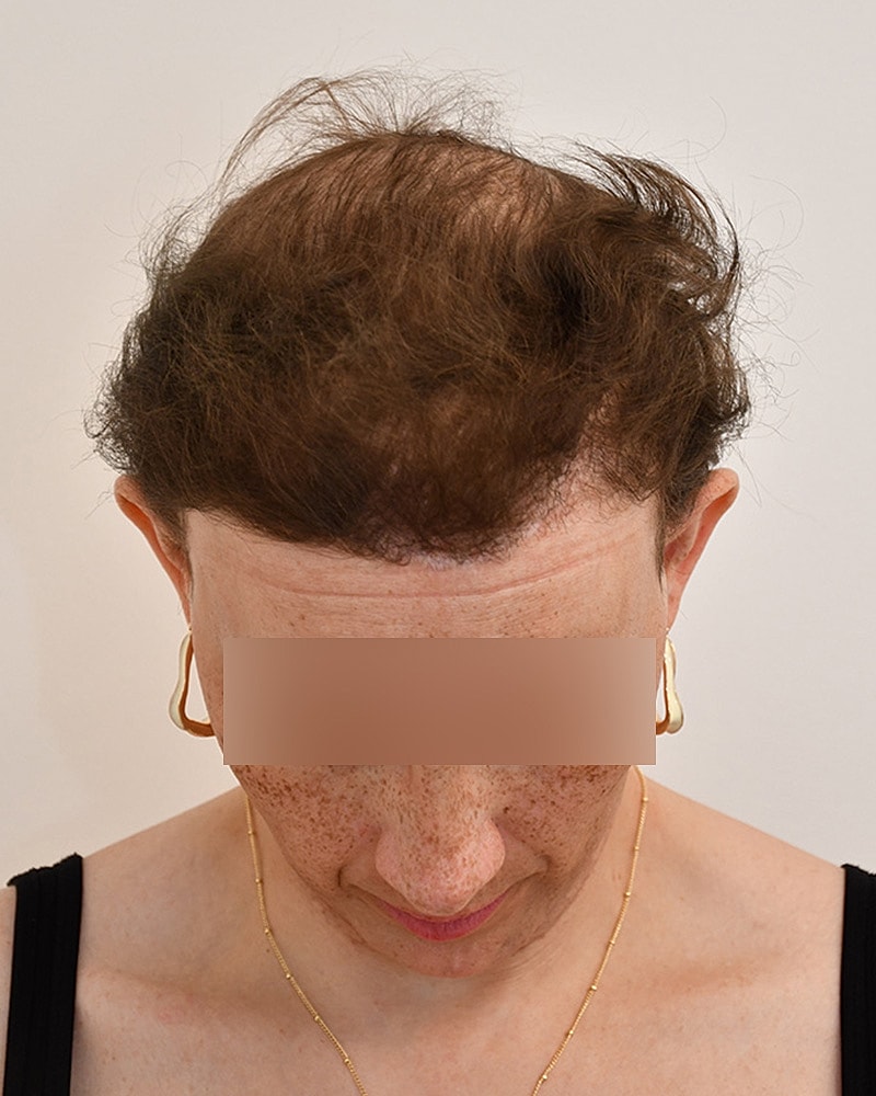 Gender-Affirming Hair Transplant (MTF) Before & After