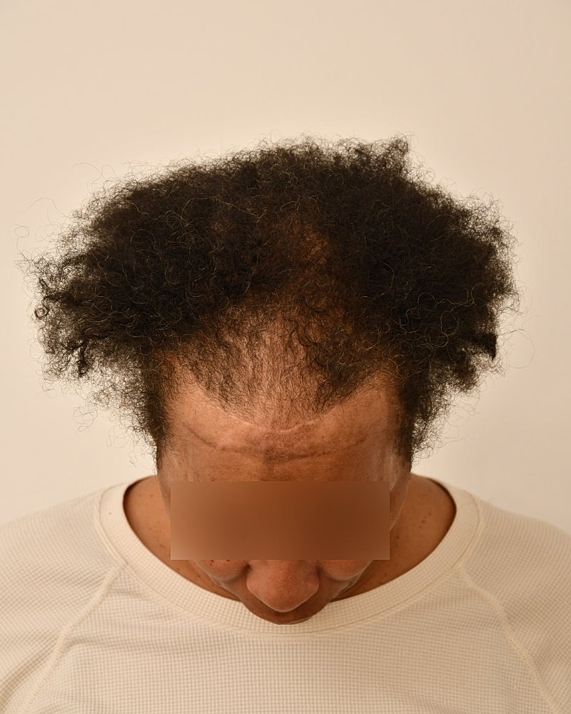 Gender-Affirming Hair Transplant (MTF) Before & After