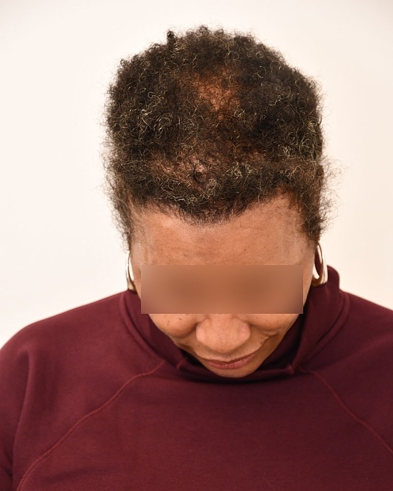 Gender-Affirming Hair Transplant (MTF) Before & After