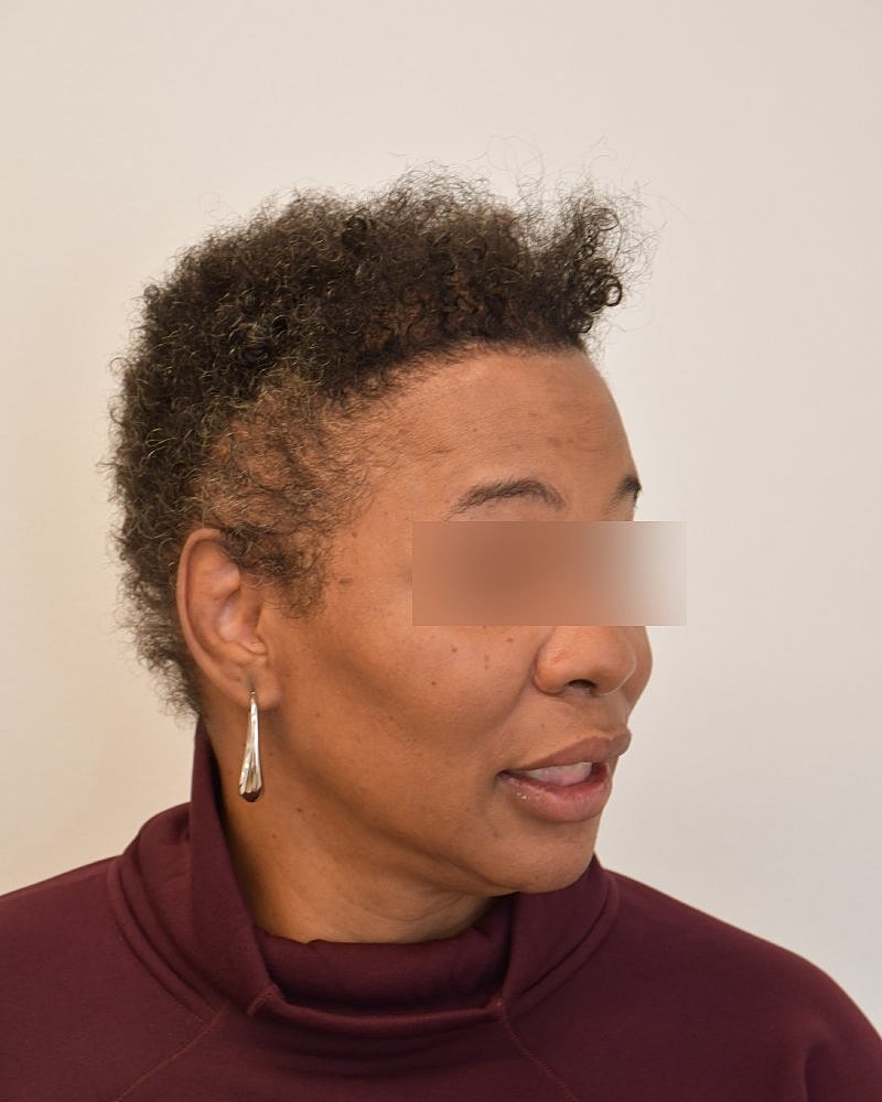 Gender-Affirming Hair Transplant (MTF) Before & After