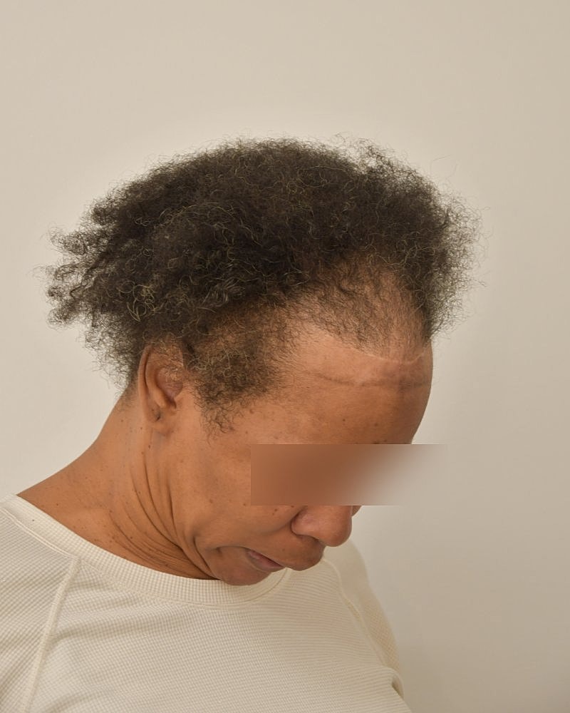 Gender-Affirming Hair Transplant (MTF) Before & After