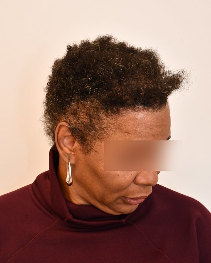 Gender-Affirming Hair Transplant (MTF) Before & After