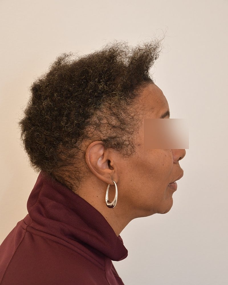 Gender-Affirming Hair Transplant (MTF) Before & After