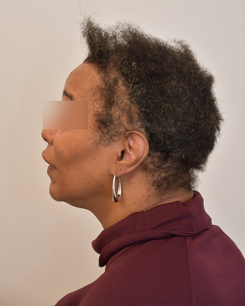 Gender-Affirming Hair Transplant (MTF) Before & After