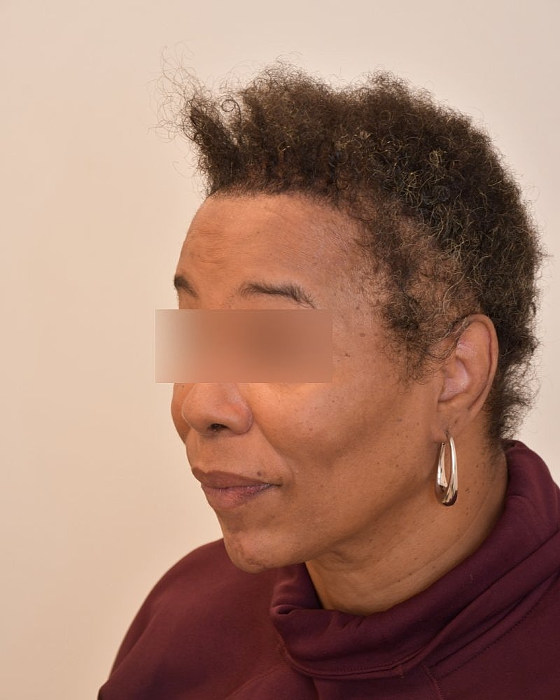 Gender-Affirming Hair Transplant (MTF) Before & After