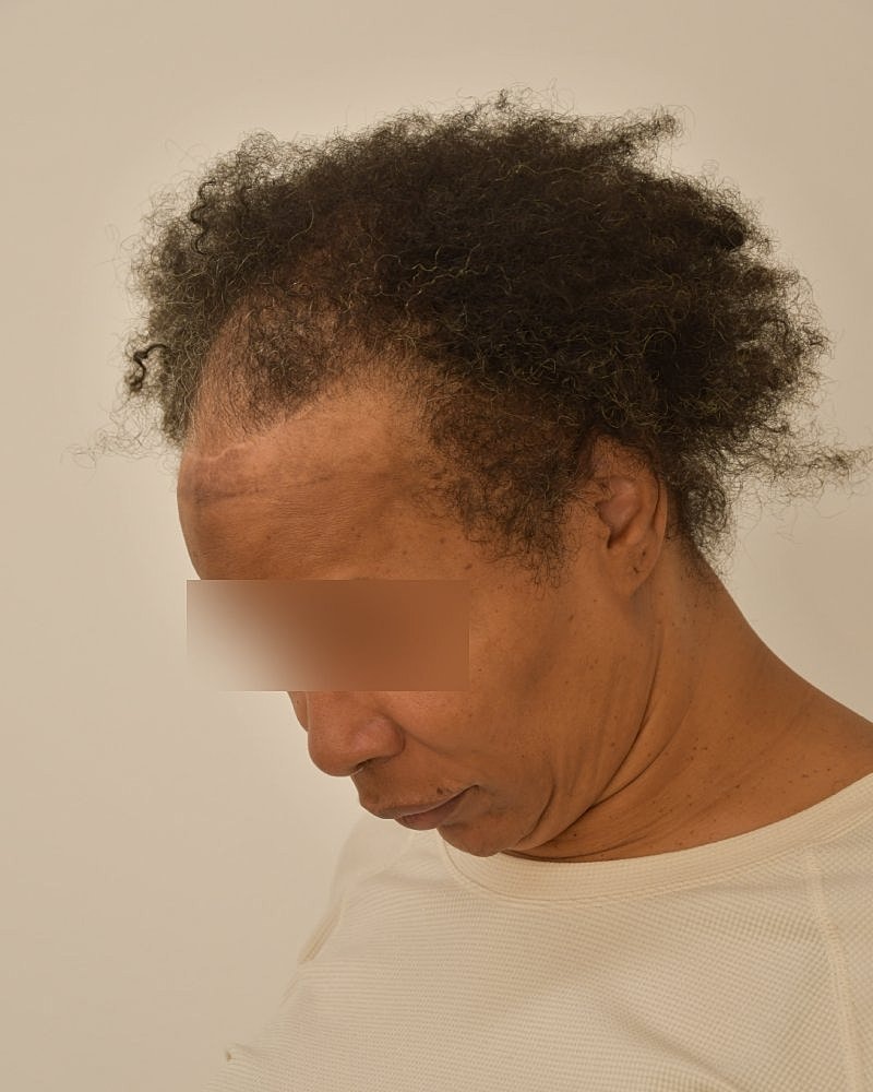 Gender-Affirming Hair Transplant (MTF) Before & After