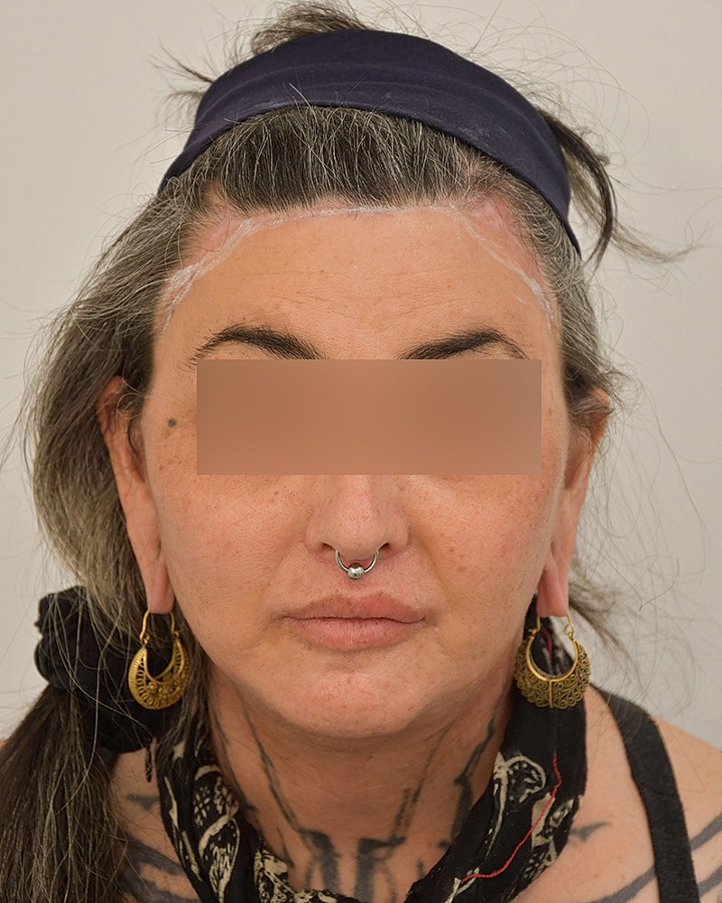 Gender-Affirming Hair Transplant (MTF) Before & After