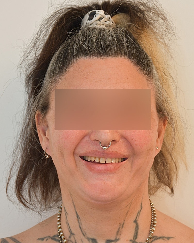 Gender-Affirming Hair Transplant (MTF) Before & After