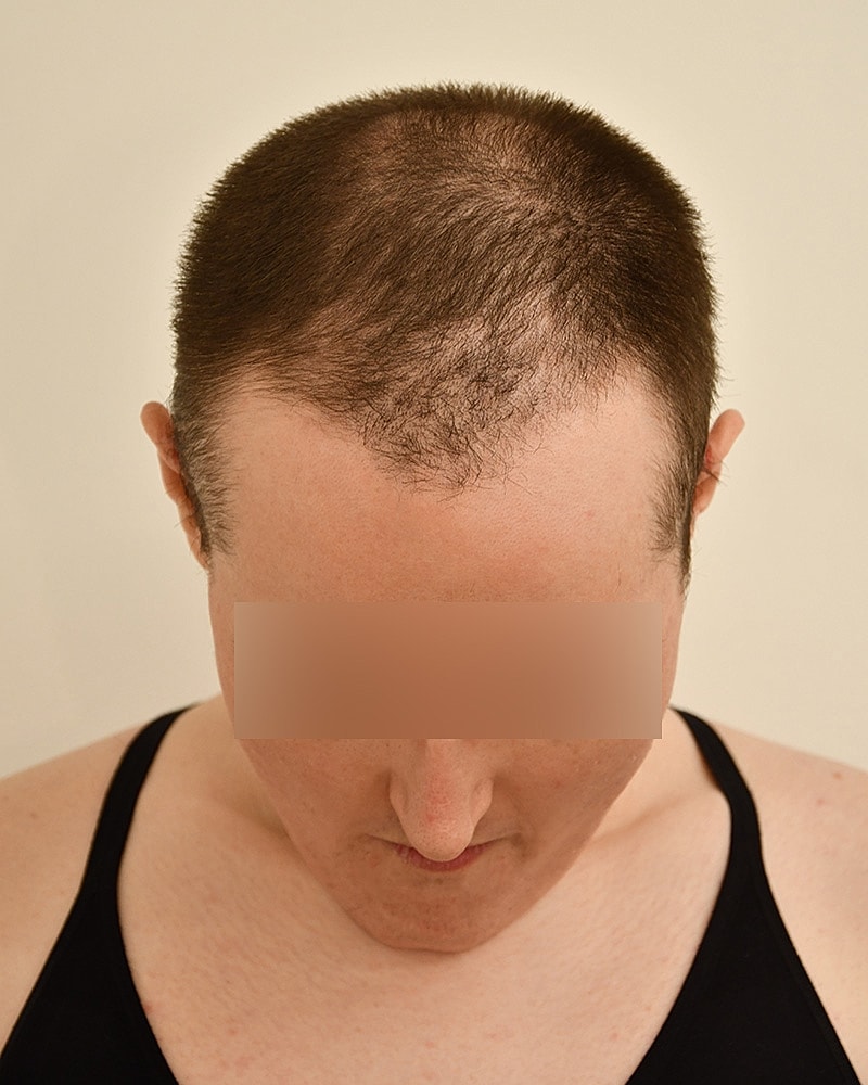 Gender-Affirming Hair Transplant (MTF) Before & After