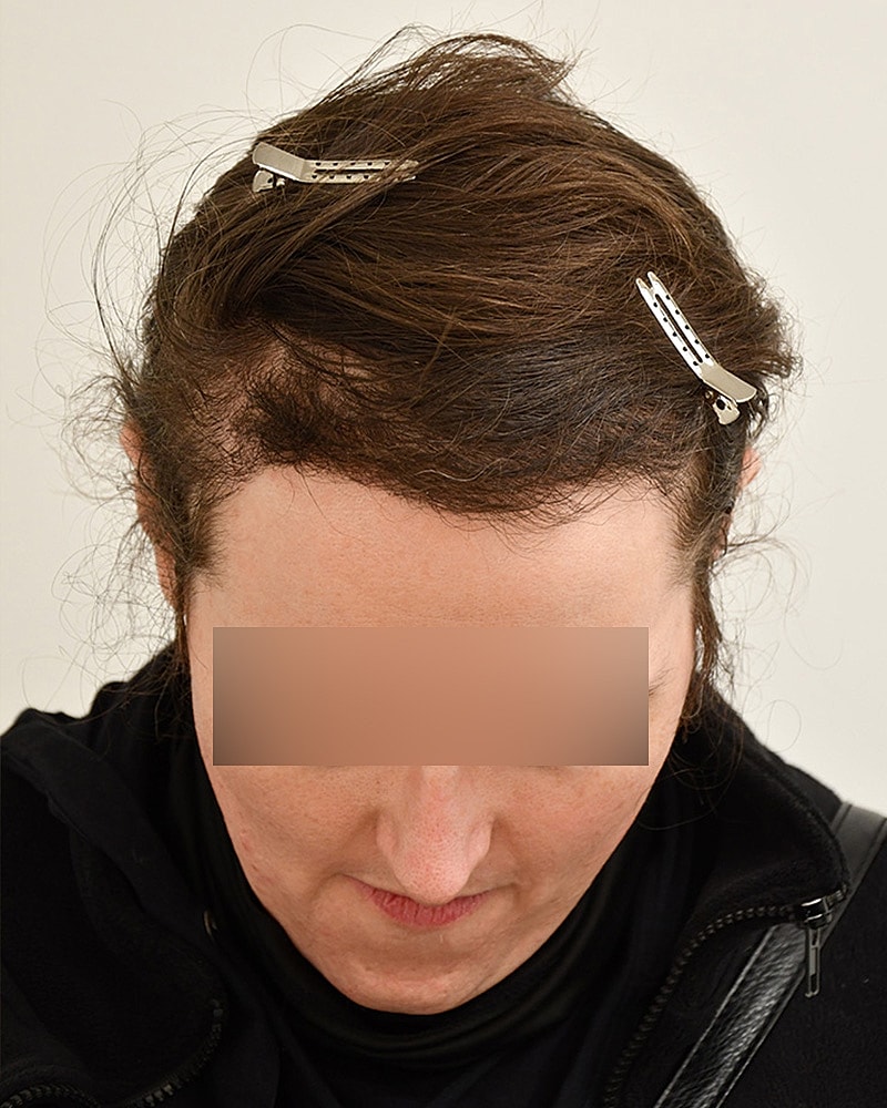 Gender-Affirming Hair Transplant (MTF) Before & After