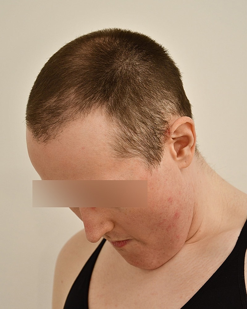 Gender-Affirming Hair Transplant (MTF) Before & After