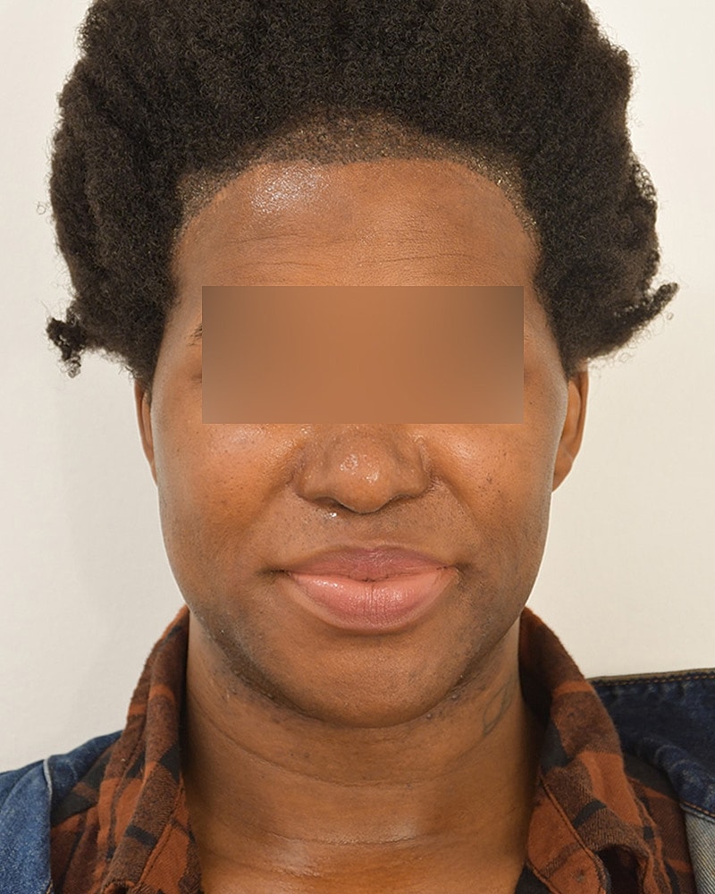 Gender-Affirming Hair Transplant (MTF) Before & After