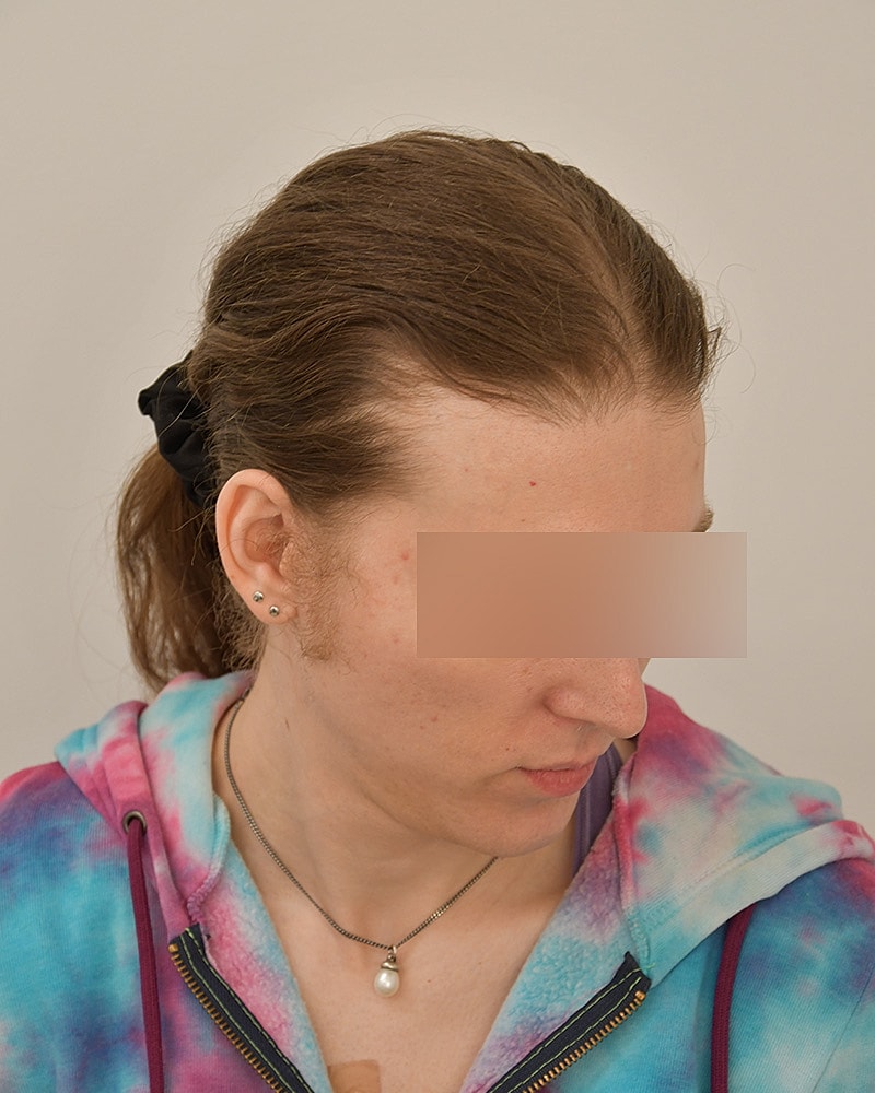 Gender-Affirming Hair Transplant (MTF) Before & After