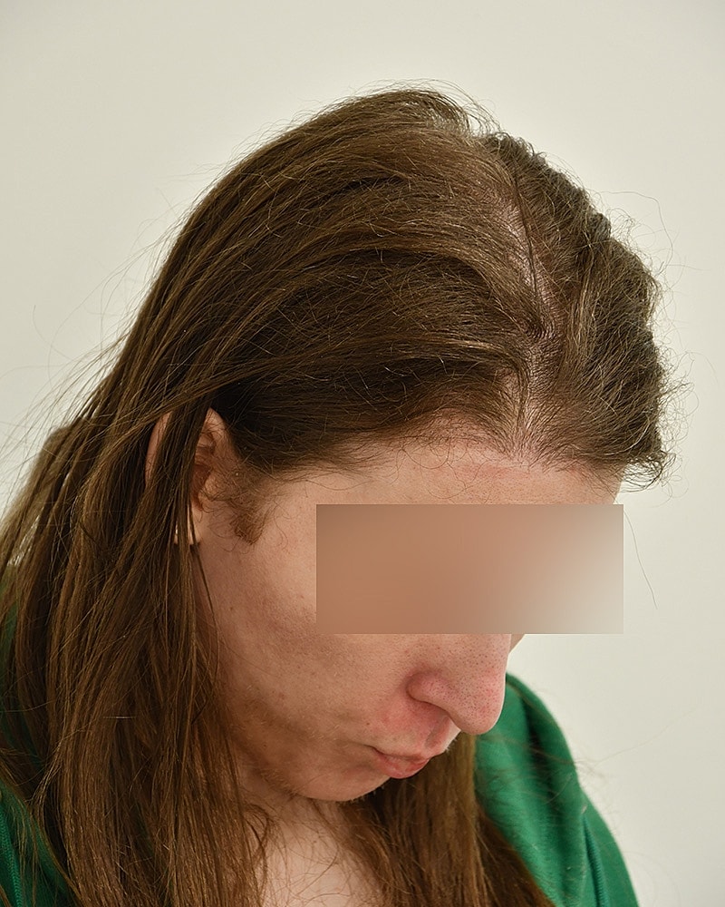 Gender-Affirming Hair Transplant (MTF) Before & After