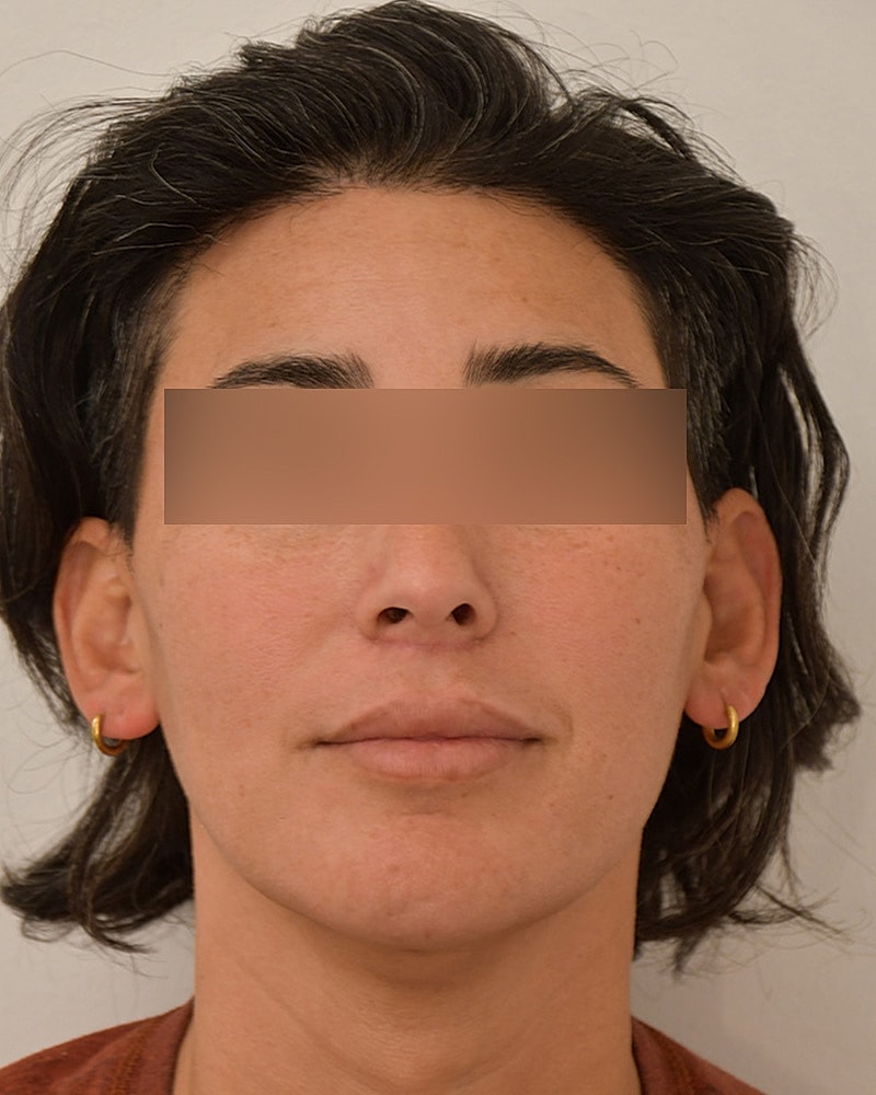 Gender-Affirming Hair Transplant (MTF) Before & After