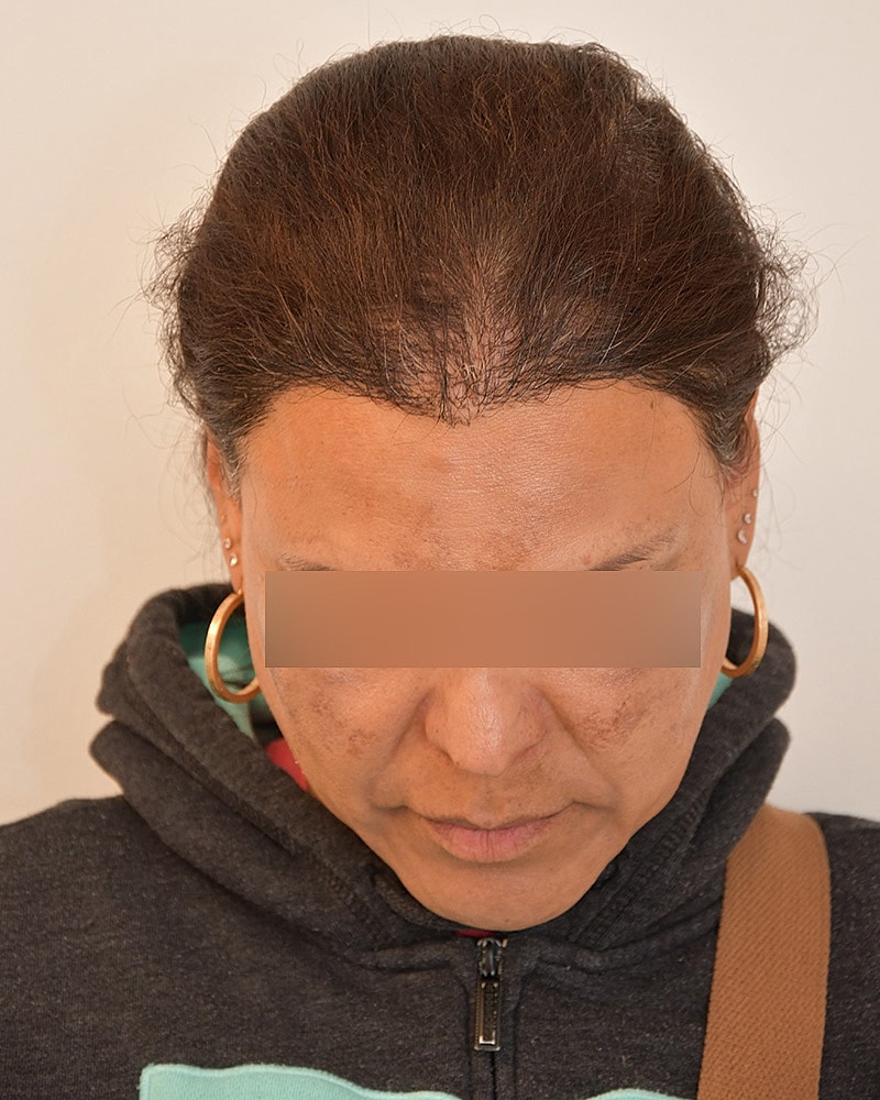 Gender-Affirming Hair Transplant (MTF) Before & After