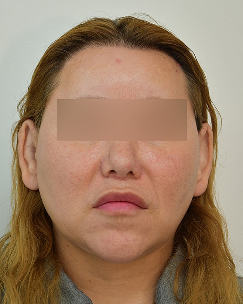 Gender-Affirming Hair Transplant (MTF) Before & After