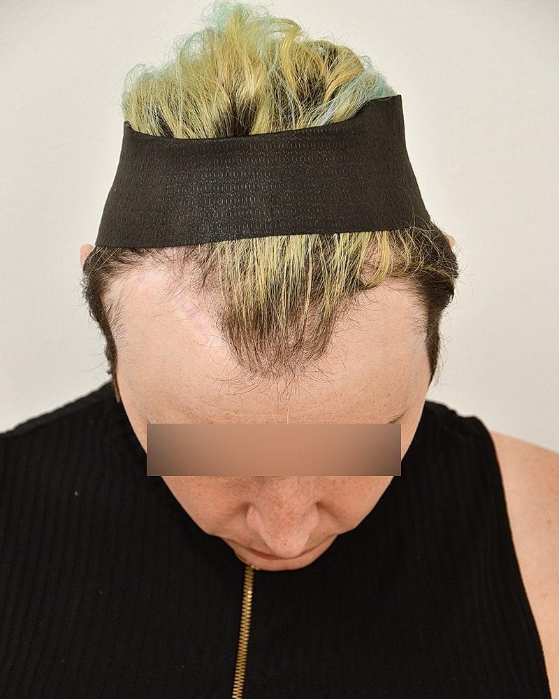 Gender-Affirming Hair Transplant (MTF) Before & After