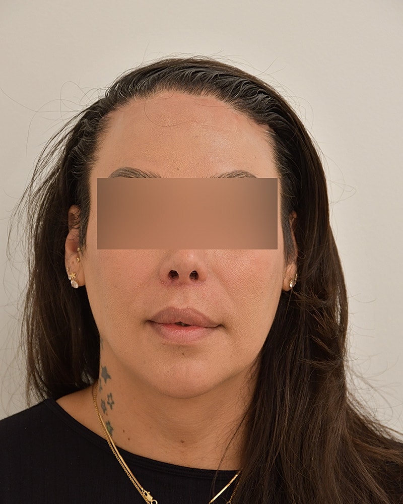 Gender-Affirming Hair Transplant (MTF) Before & After