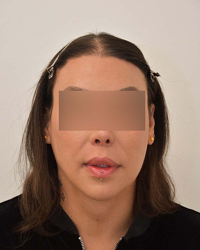 Gender-Affirming Hair Transplant (MTF) Before & After