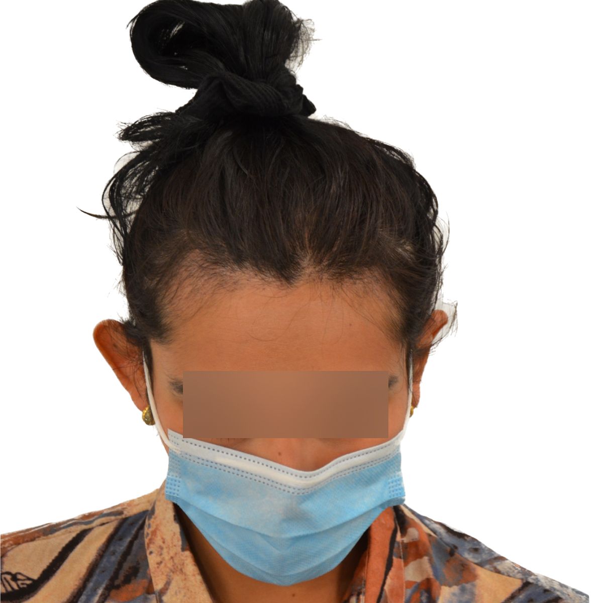 gender affirming hair transplant before