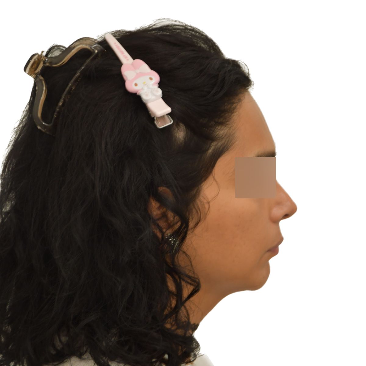 gender affirming hair transplant after