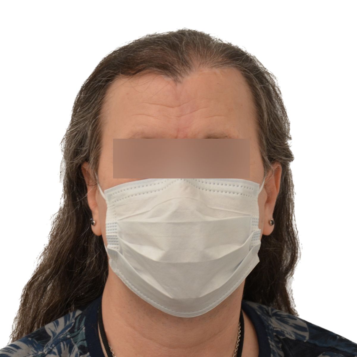 gender affirming hair transplant before