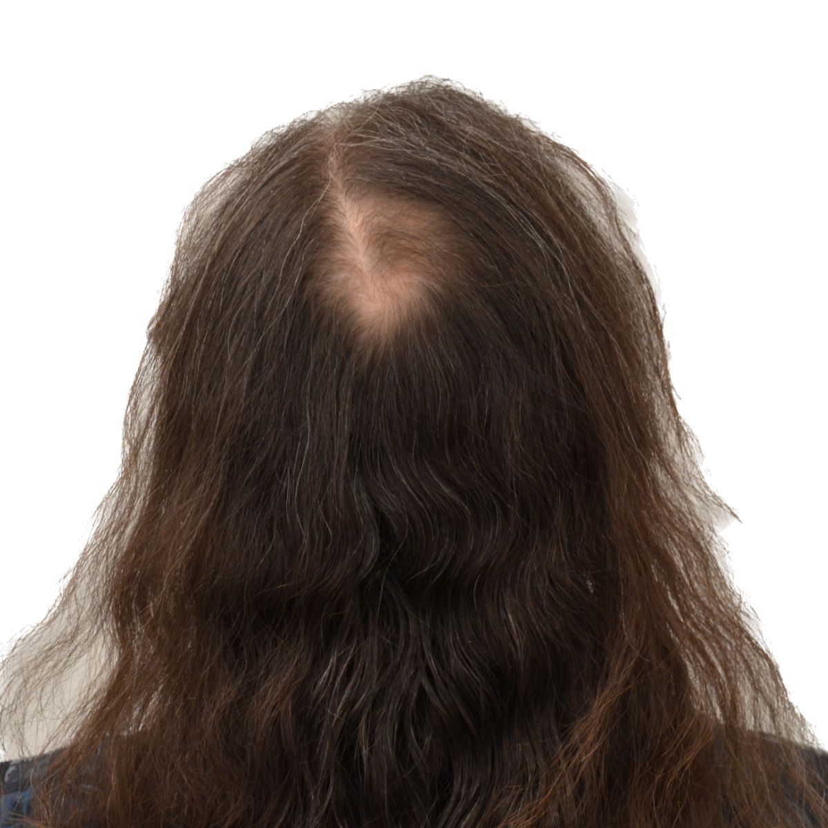 gender affirming hair transplant before