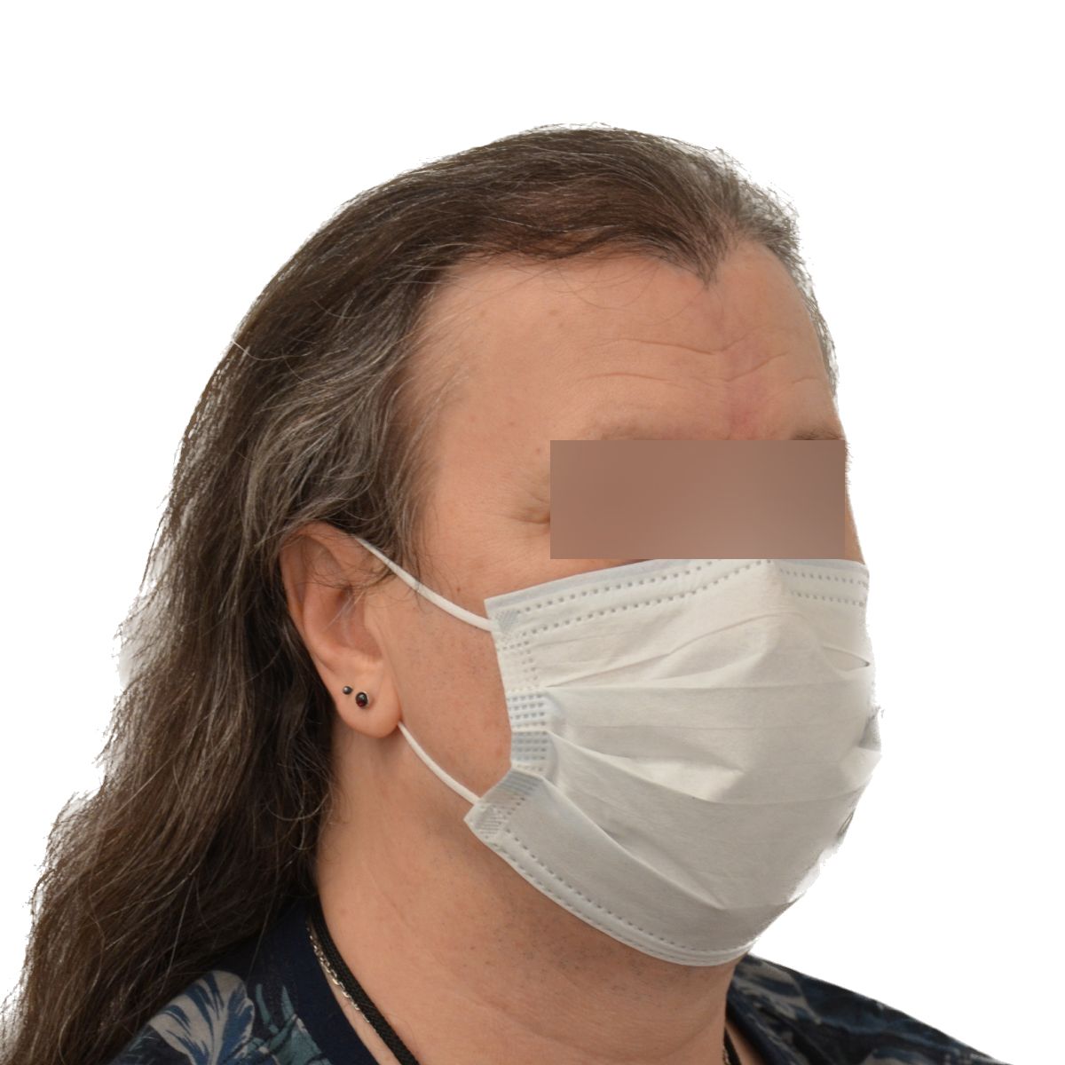 gender affirming hair transplant before