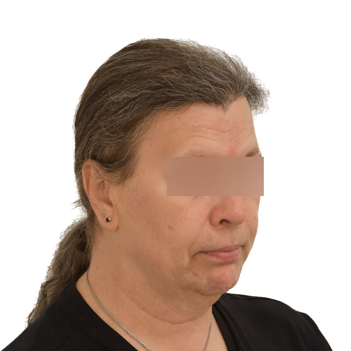 gender affirming hair transplant after