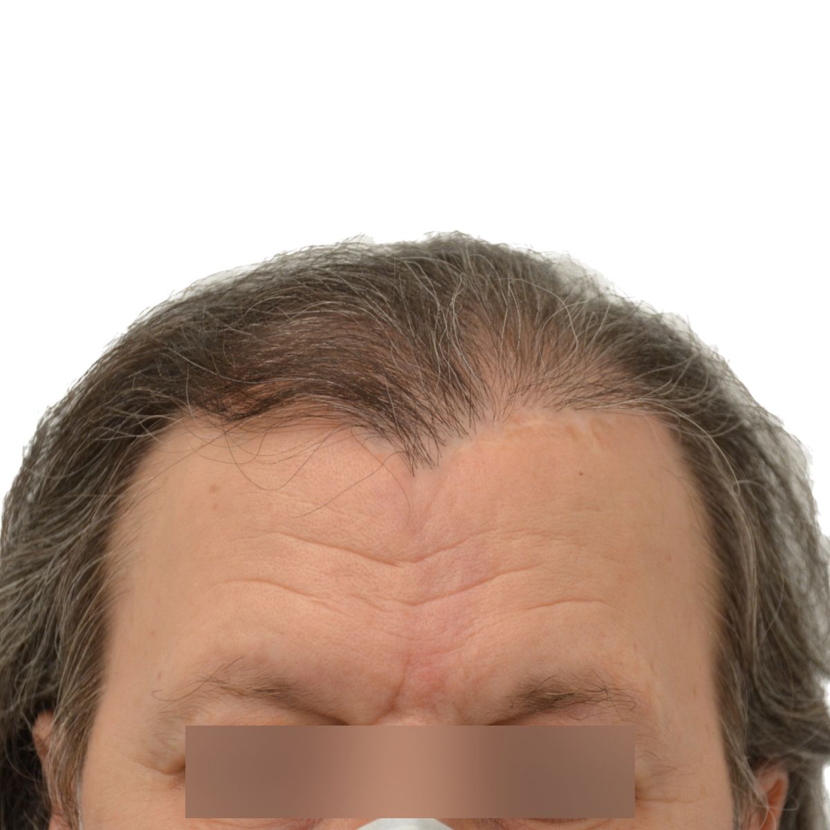 gender affirming hair transplant before