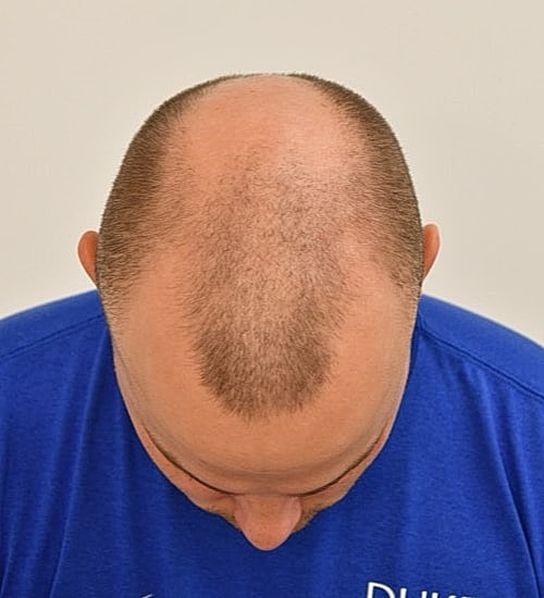 Balding man looking down, thinning hair visible.
