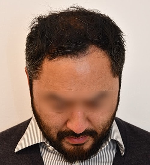 Man with hair loss looking downwards.