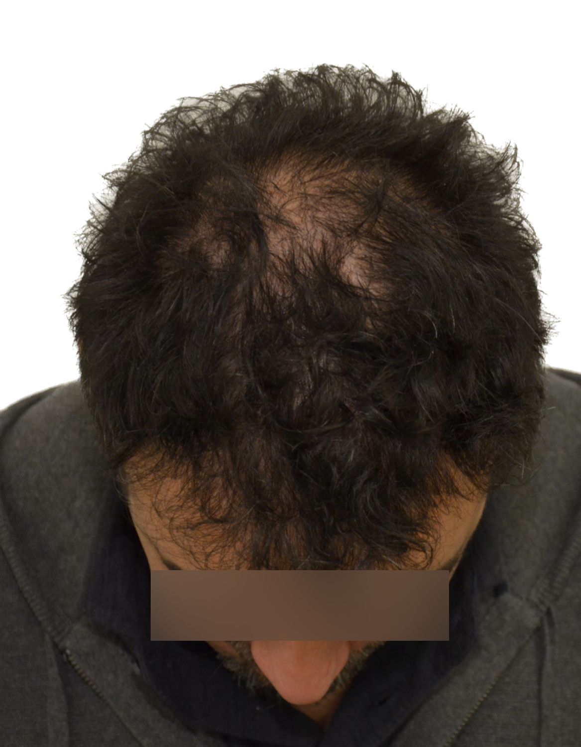 hair transplant before